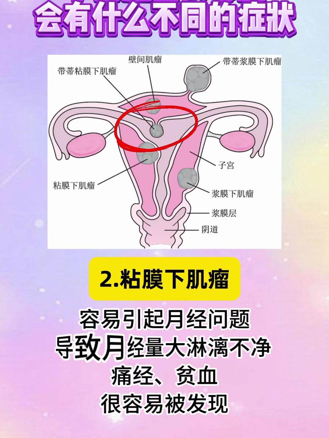 子宫长了个瘤子是什么原因导致的，子宫长了个瘤子是什么原因导致的怎么治疗