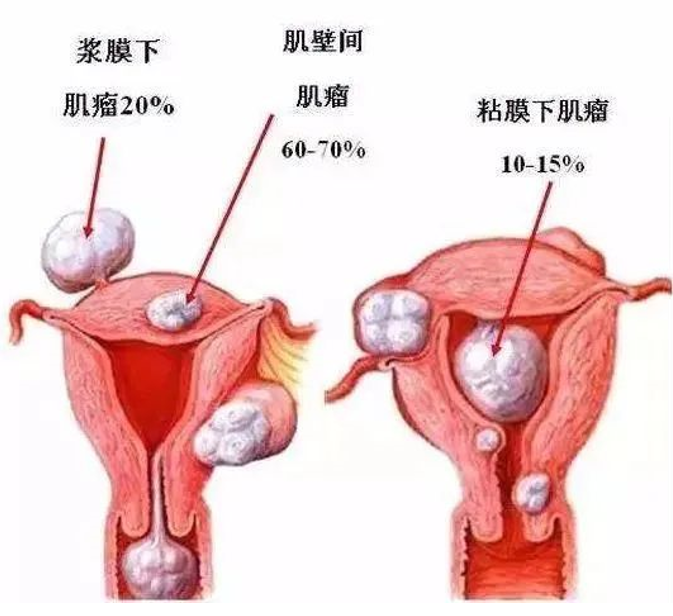 子宫平滑肌瘤是怎么回事啊，子宫平滑肌瘤是什么原因引起的