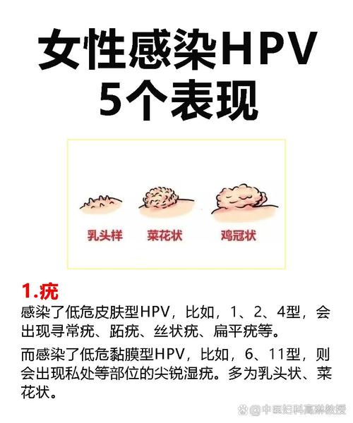 女人感染hpv最明显表现,女人感染hpv最明显表现症状